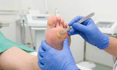 corn-callus-removal-chiropodist-dublin