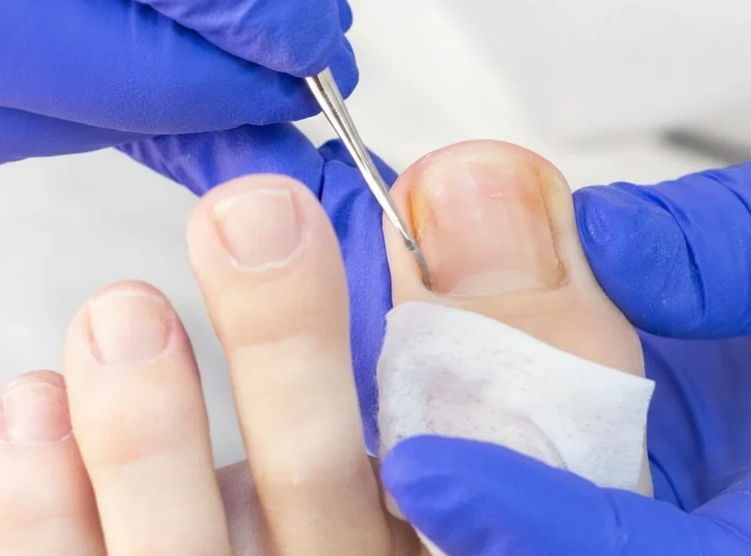 ingrown-toenail-treatment-podiatry-dublin