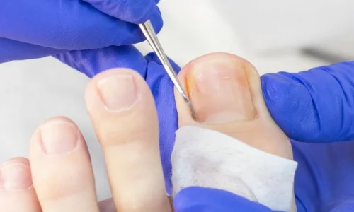 ingrown-toenail-treatment-podiatry-dublin