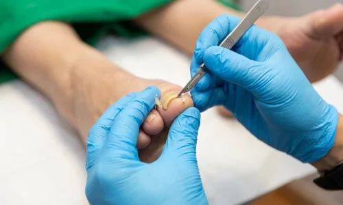 nail-surgery-podiatrist-dublin